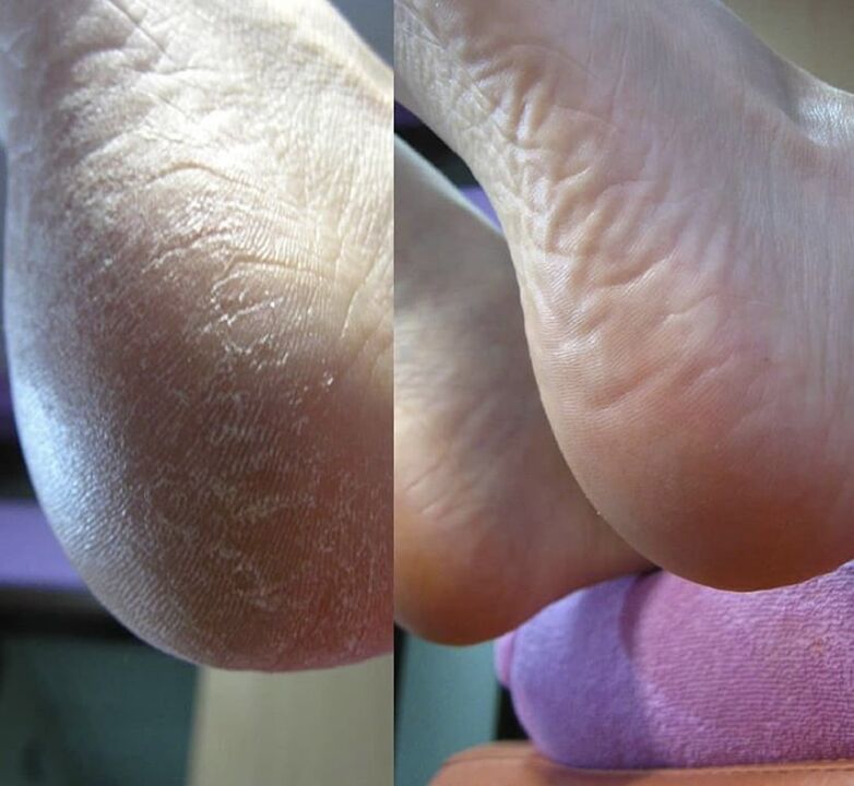 Foto der Ferse des Fußes vor und nach der Anwendung der Zenidol-Creme