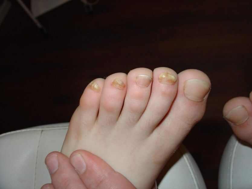 symptome nagelpilz