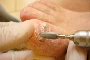 Mechanisches Schneiden der Nagelplatte