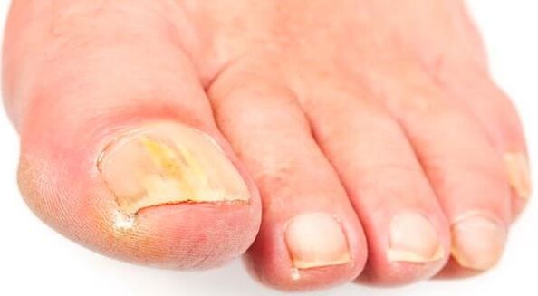 Nagelpilz