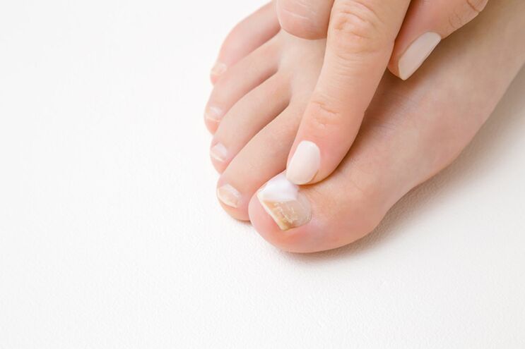 Behandlung der Finger mit Salbe aus dem Pilz