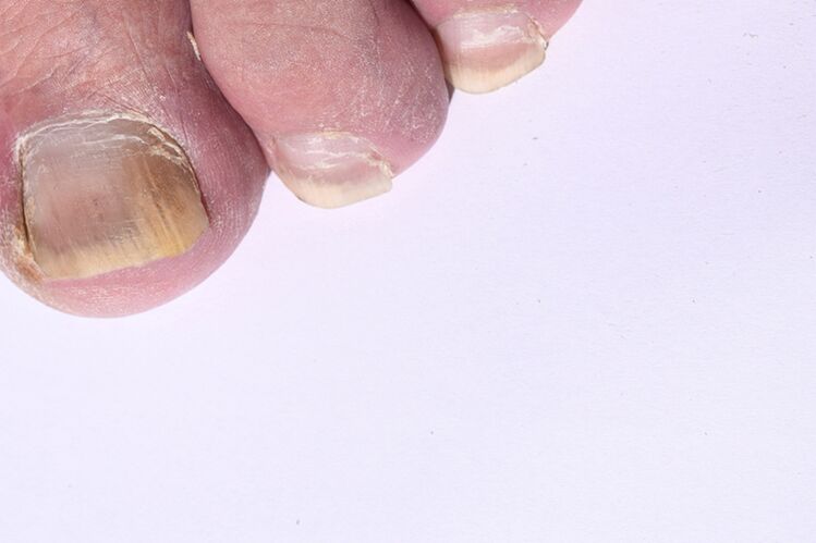 Die Anfangsphase der Mykose der Nägel an den Beinen