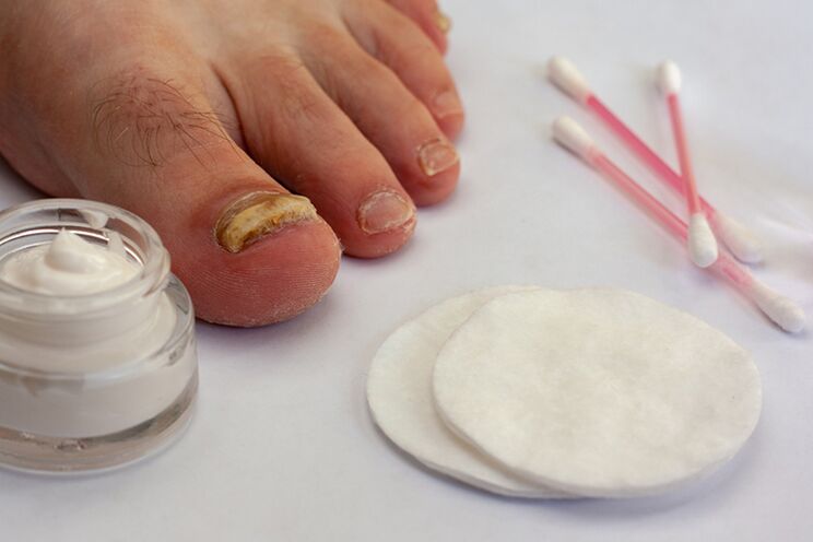 Pilzfingerbehandlung mit Pilzcreme