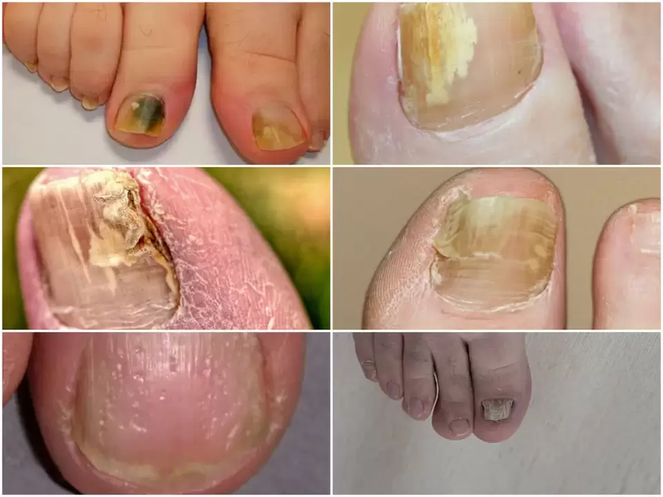Symptome einer Onychomykose sind Veränderungen in der Farbe und Struktur der Nägel