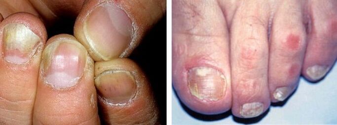 Manifestationen einer Pilzinfektion auf den Nägeln