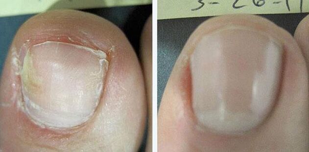 vor und nach der Nagelpilzbehandlung